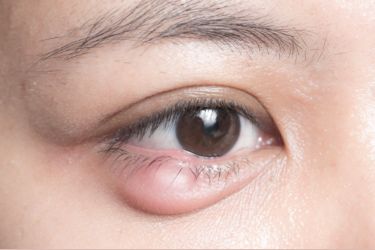 When should I see an oculoplasty specialist_