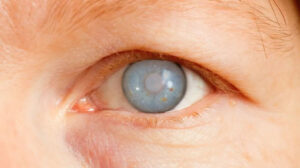 Free from eye diseases such as glaucoma or cataracts