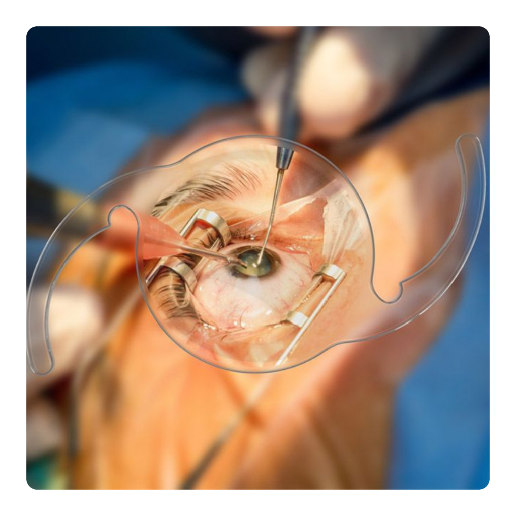 "Cataract surgery at Shanthinethralaya Eye Hospital, performed by Dr. B. Shanthi Niketh"