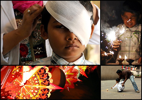 Child with eye injury due to Diwali firecracker accident