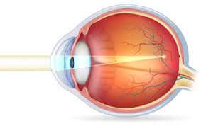 "Diagram of the human eye showing the focus of light on the retina, representing refractive errors like myopia, hyperopia, and astigmatism."