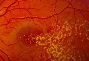 drusen-Macular-Degeneration