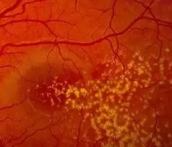 drusen-Macular-Degeneration