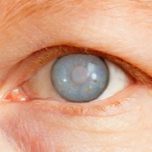 glaucoma-symptoms