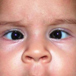 squint-eye-causes-treatment